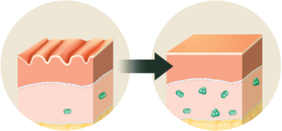 주름 개선 : 진피재생
