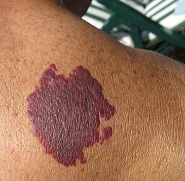 화염상 모반, Nevus flammeus (포도주색 반점, Port-wine stain)