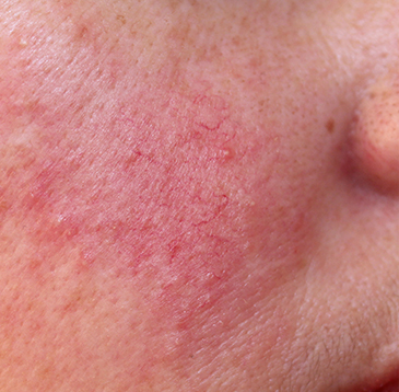 주사 Rosacea